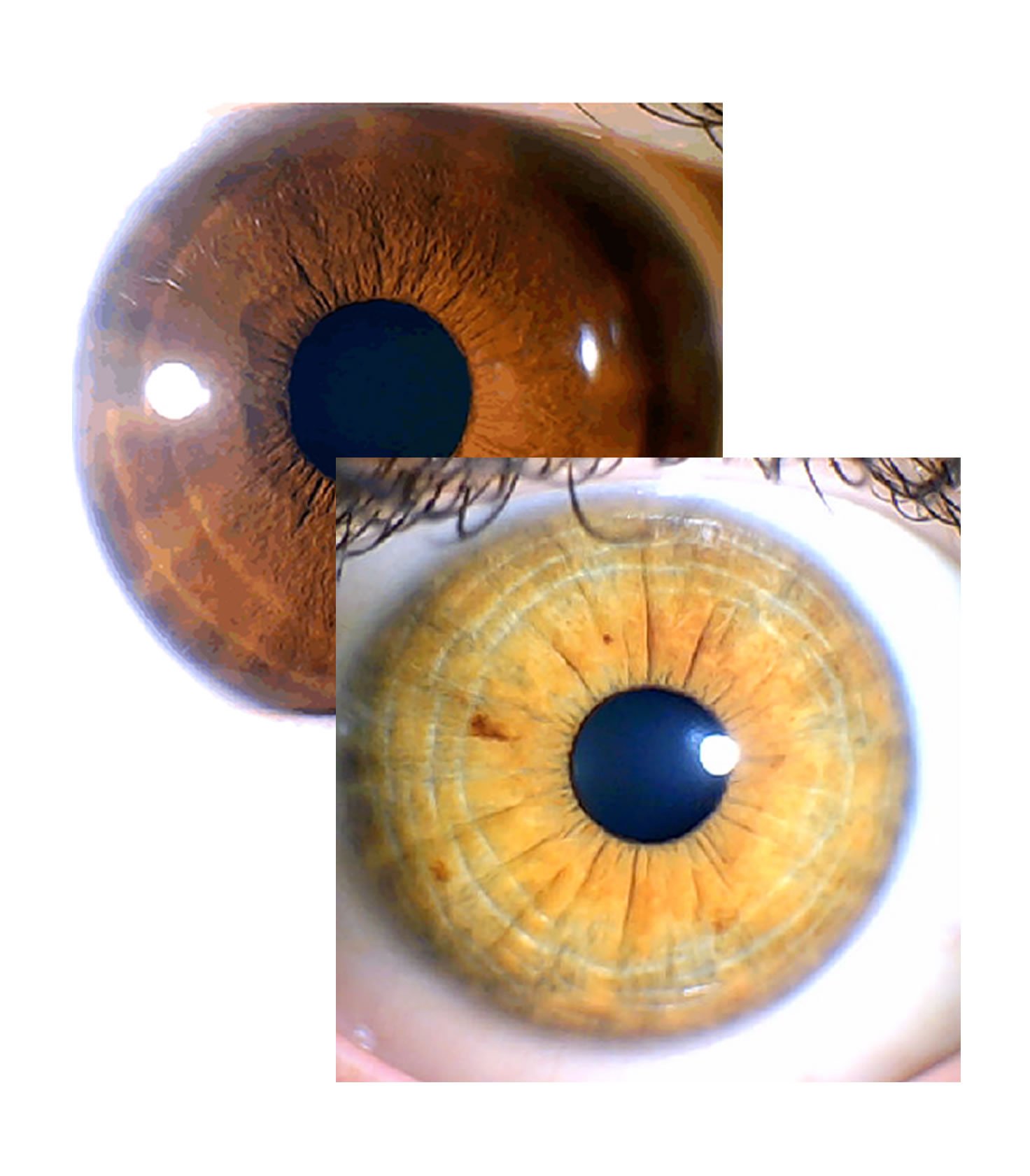 Arco Senil para Iridólogos