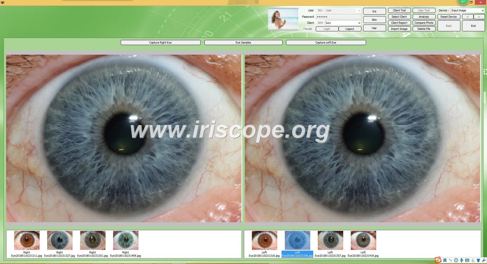 Iridoscopia Digital Computarizada