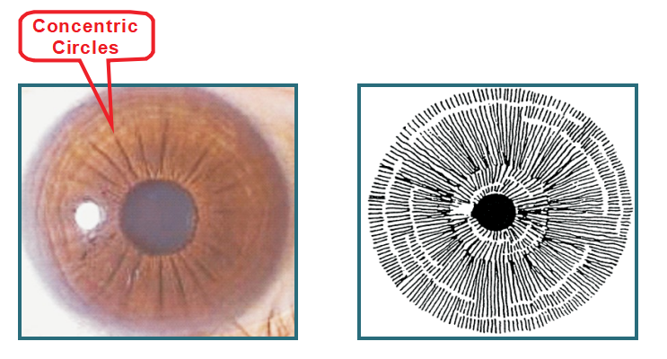 Capítulo 6 Los principales signos y marcas del iris – 6.4 Círculos concéntricos
