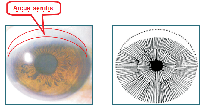 Capítulo 6 Los principales signos y marcas del iris – 6.5 Arco senil