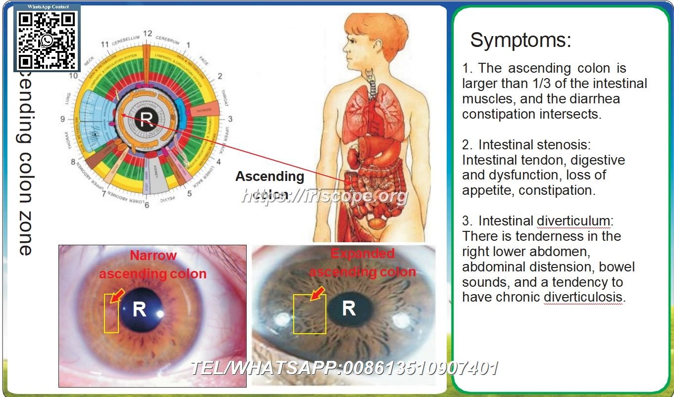8.1 Iridología: Colon Ascendente Estrecho y Colon Ascendente Dilatado – Caso 4