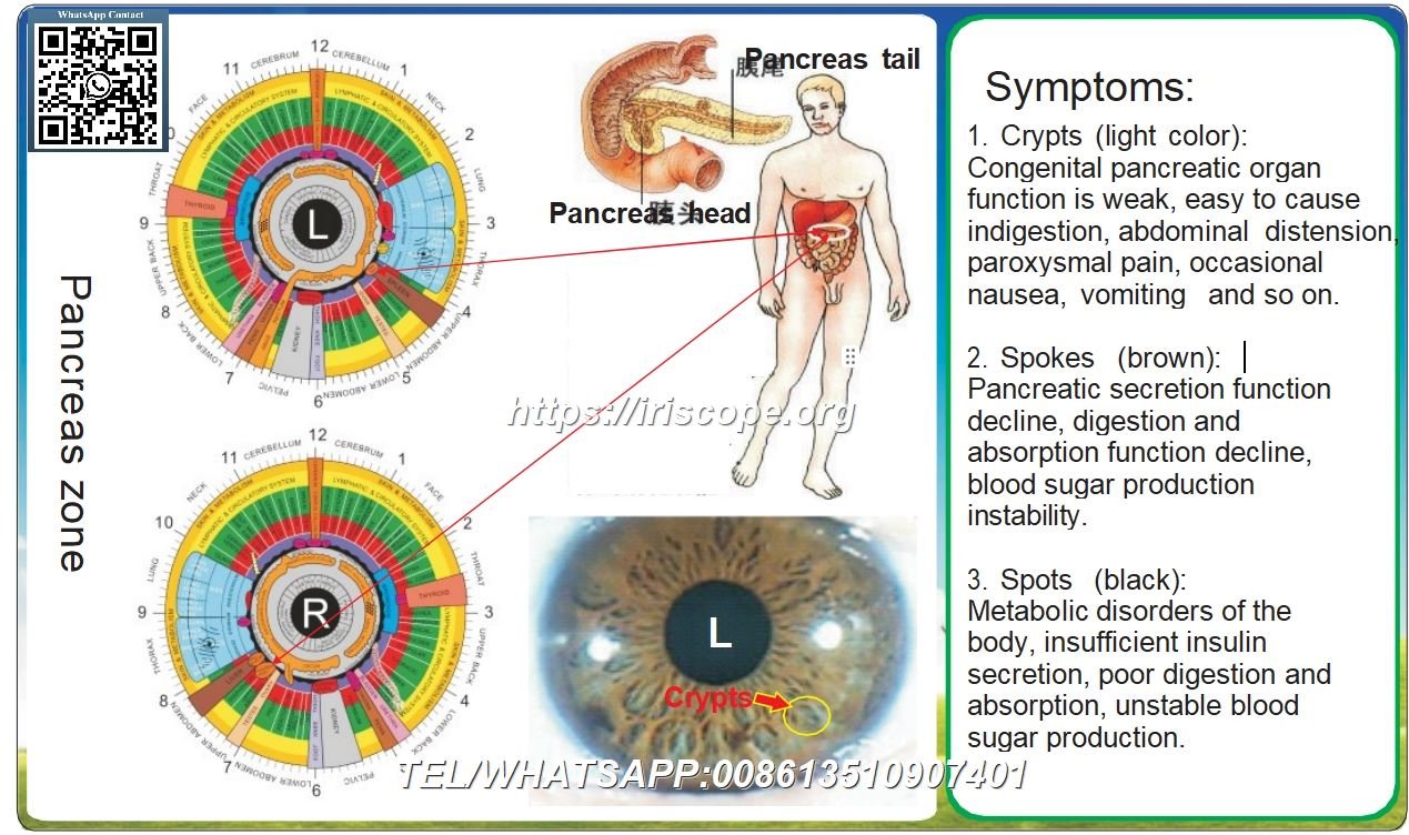 8.1 Iridología – Zona Pancreática: Interpretación de Marcas en el Iris