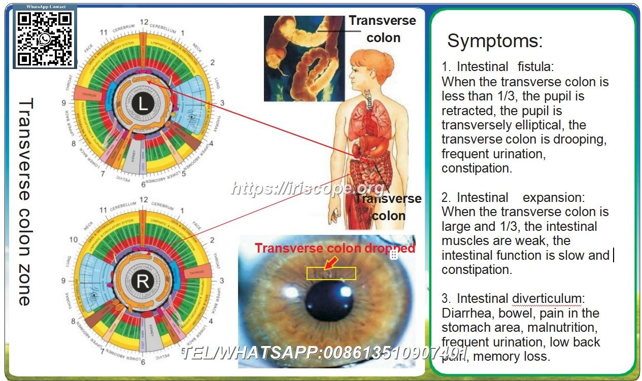 8.1 Iridología – Colon Transverso: Caso Clínico 6