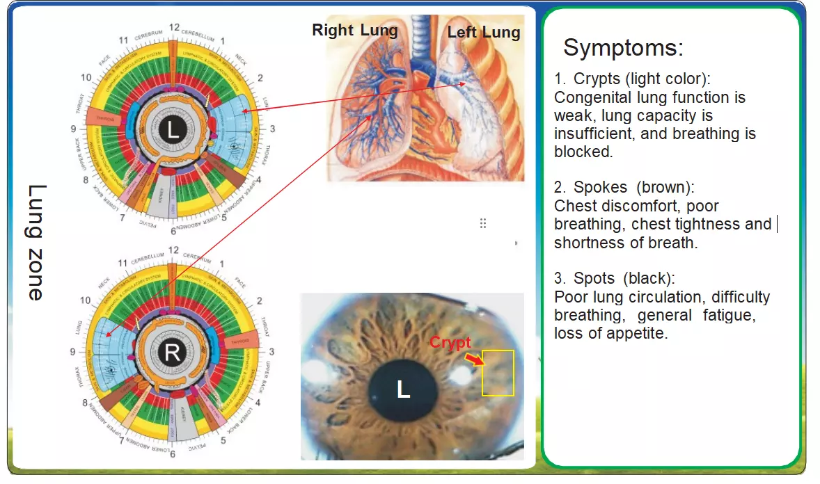  Iridología aplicada al diagnóstico pulmonar: Un análisis comparativo