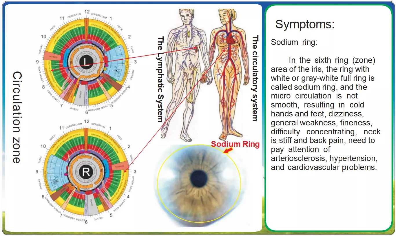 Iridología y el Anillo de Sodio: Señales Circulatorias en el Iris Un Análisis Integral del Sistema Linfático y Cardiovascular desde la Perspectiva Iridológica