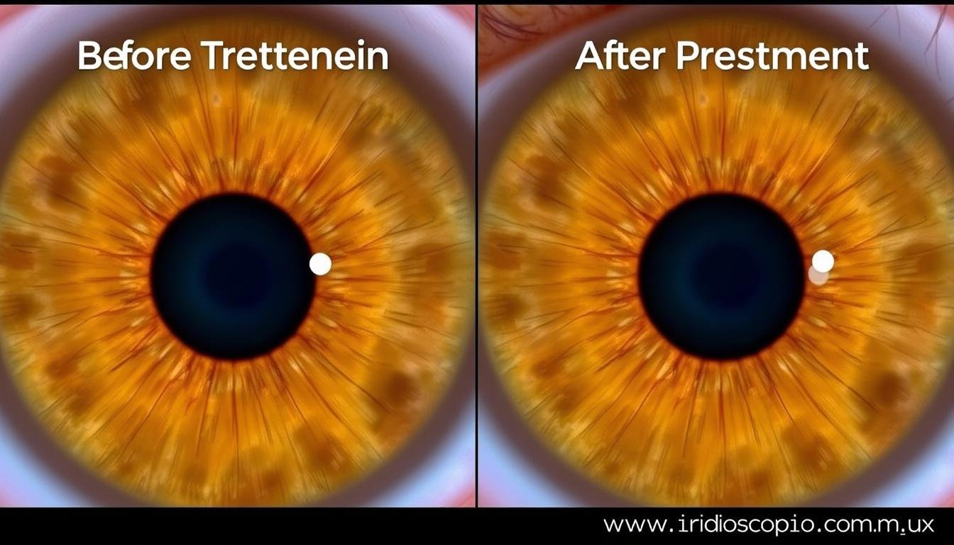 Comparativa de iris antes y después de tratamiento prostático Comparativa de iris antes y después de tratamiento prostático