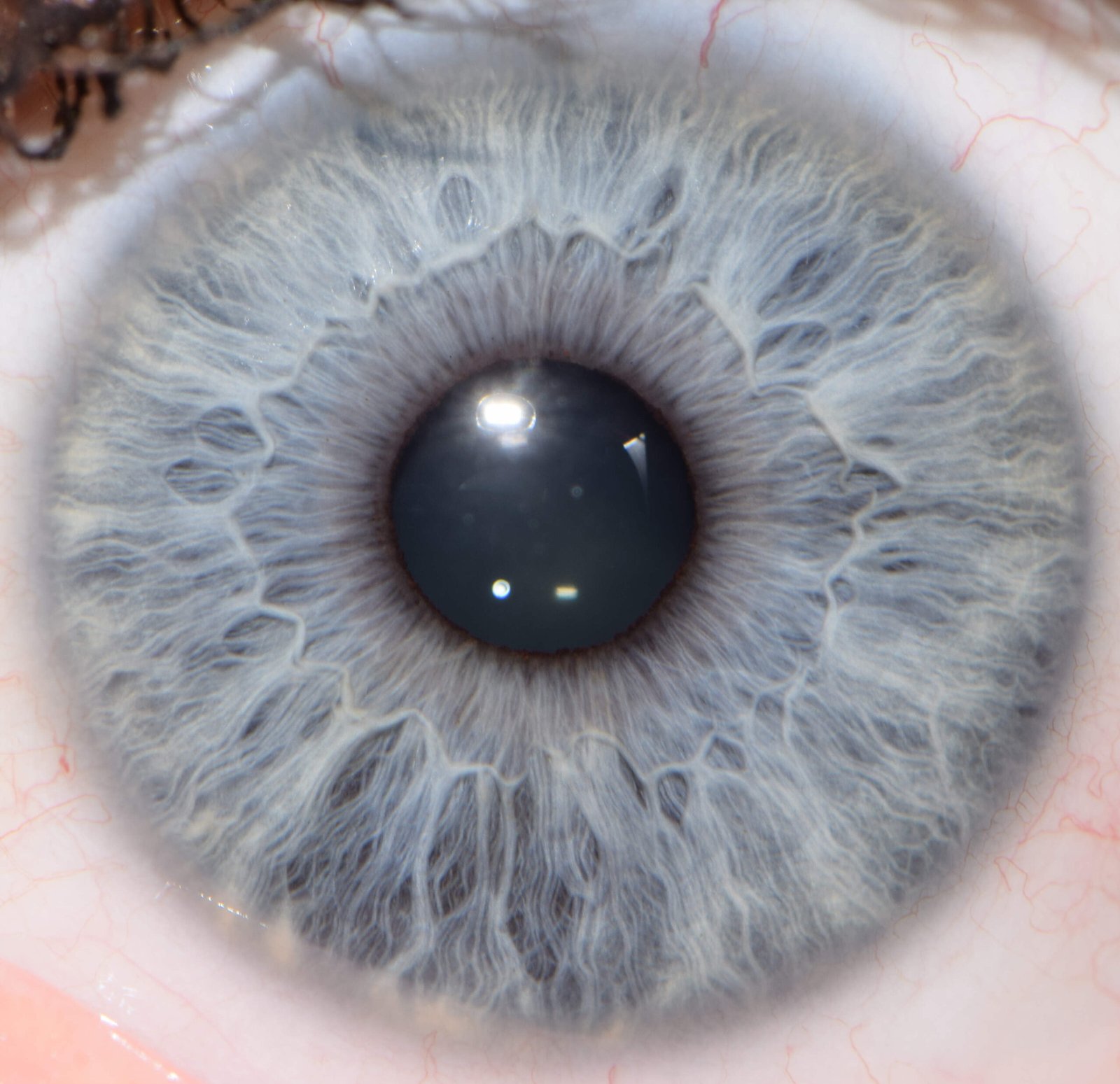 Arco Senil Iridología