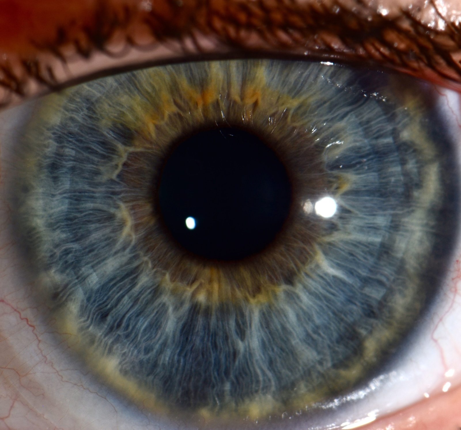 Arco Senil Iridología