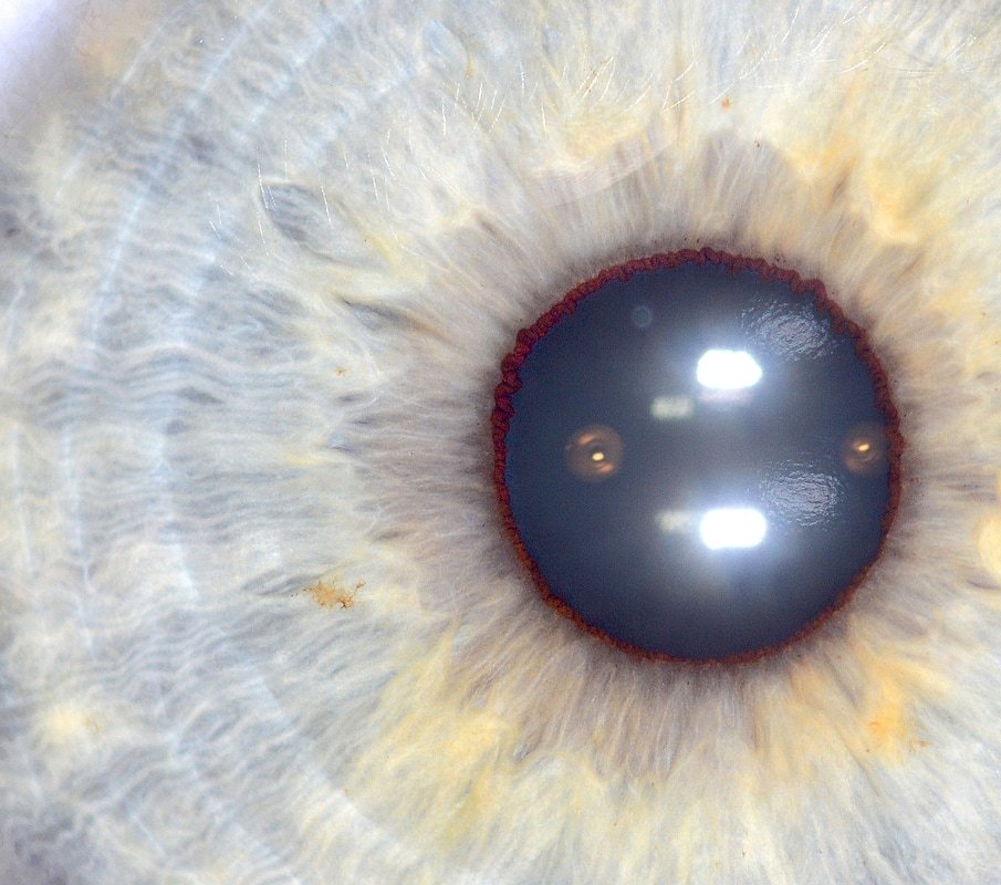 Iridologia Psora Que Es