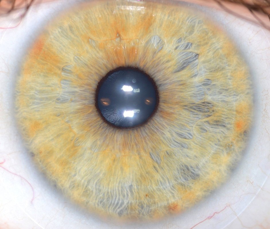 Iridologia Psora Que Es