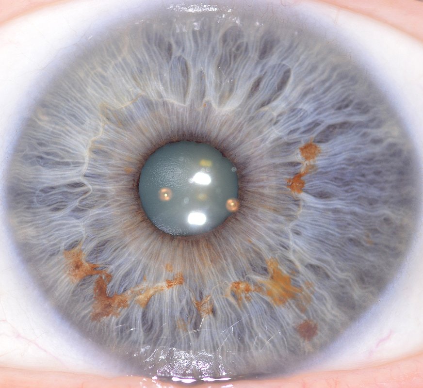 Absorción Iridología