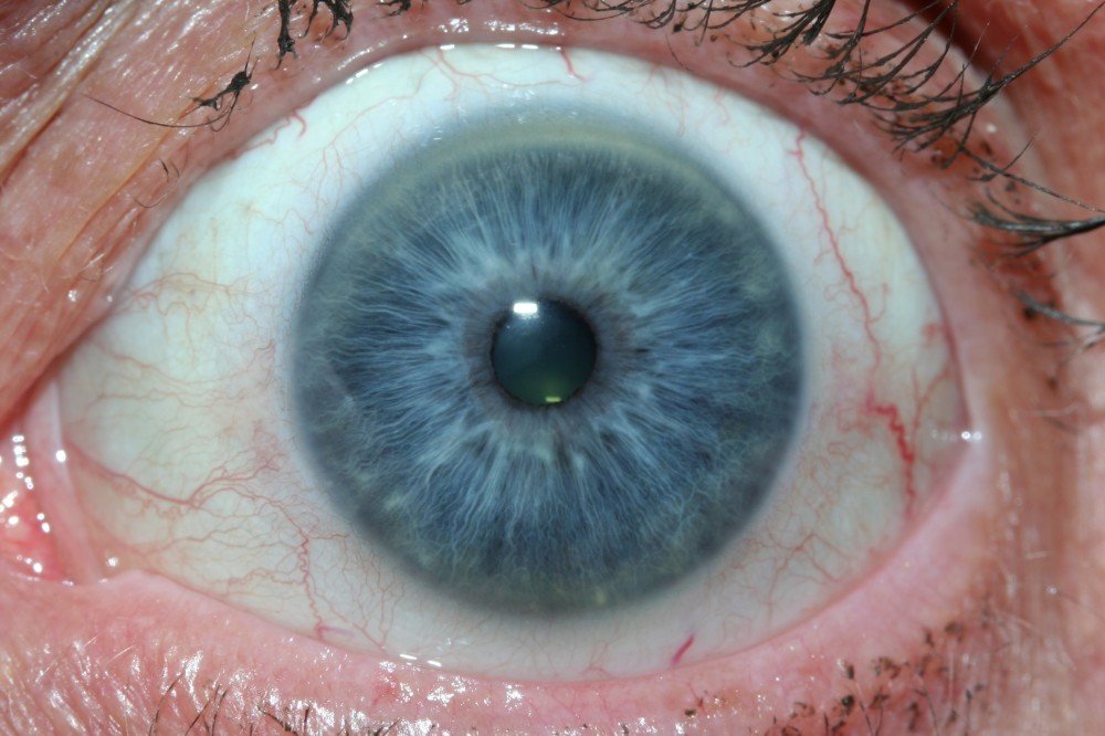 Arco Senil en Iridología
