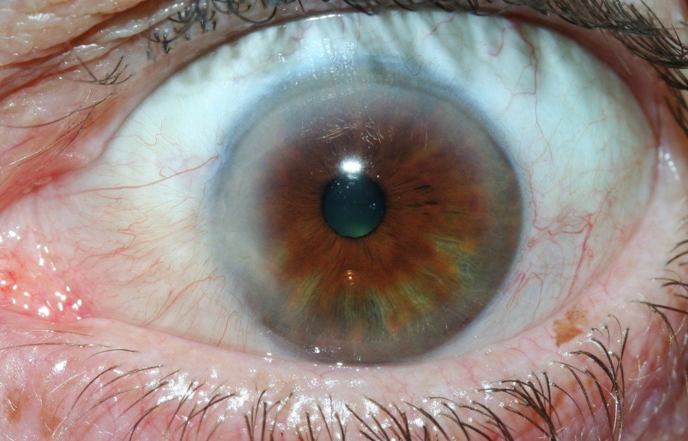 Arco Senil Iridología