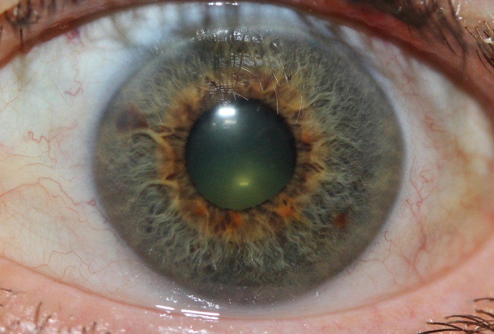 IRIDOLOGY