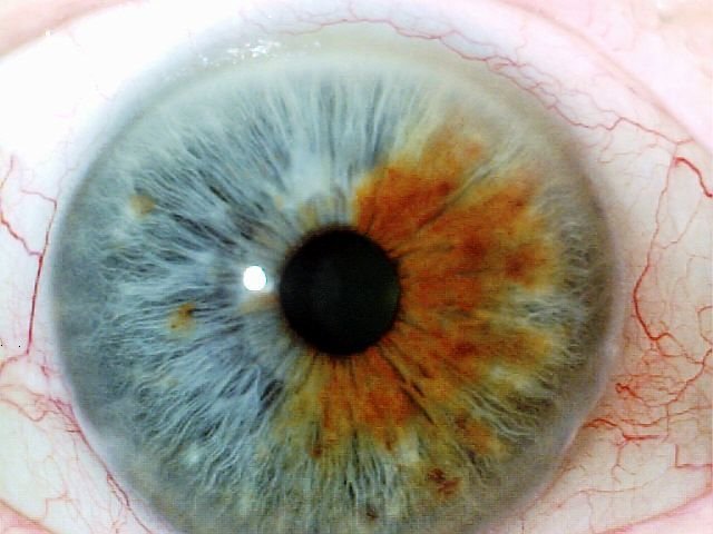 Arco Senil Iridología