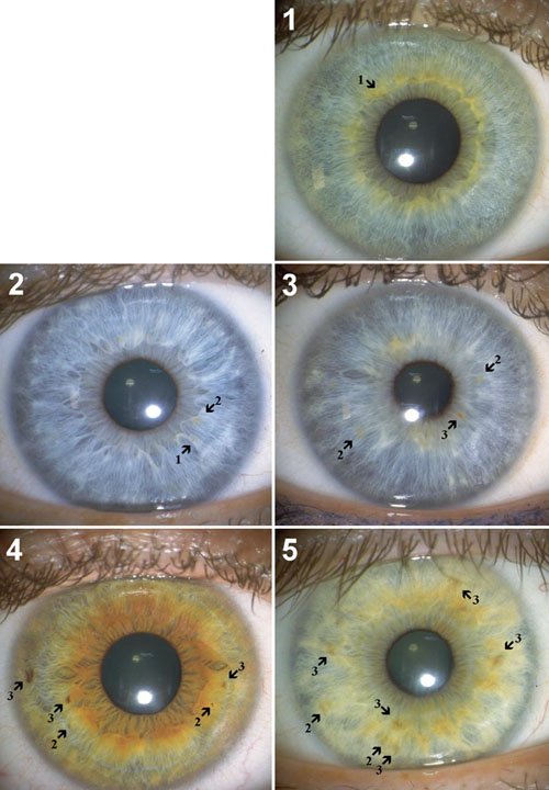 Absorción Iridología