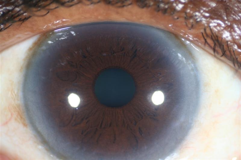 Arco Senil Iridología